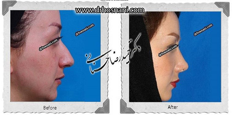 جراحی بینی