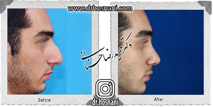 جراحی بینی