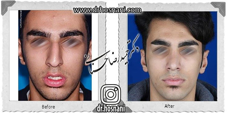 اصلاح انحراف بینی