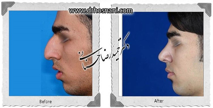 اصلاح انحراف بینی