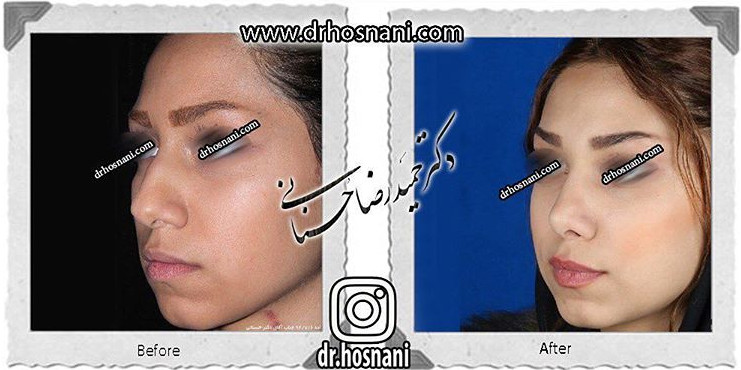 جراحی بینی