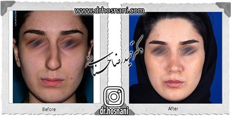 اصلاح انحراف بینی