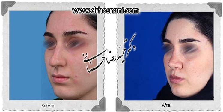 اصلاح انحراف بینی