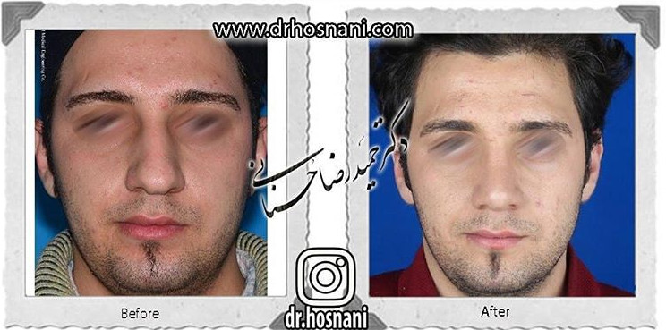 اصلاح انحراف بینی