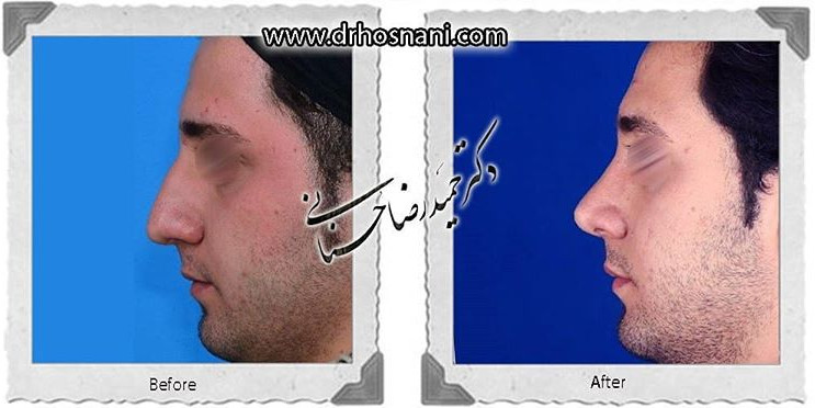 اصلاح انحراف بینی