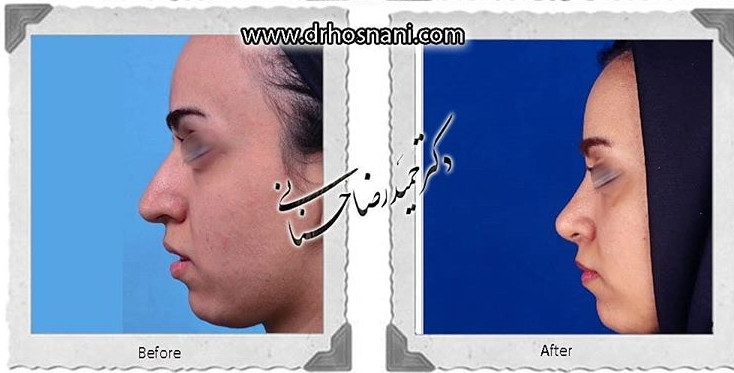 اصلاح انحراف بینی