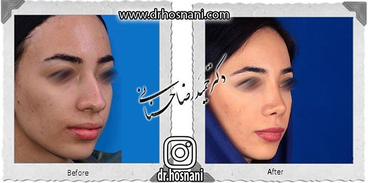 جراحی بینی