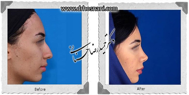 جراحی بینی