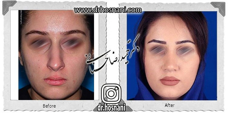 اصلاح انحراف بینی