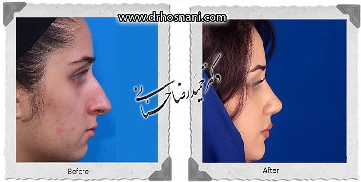 اصلاح انحراف بینی
