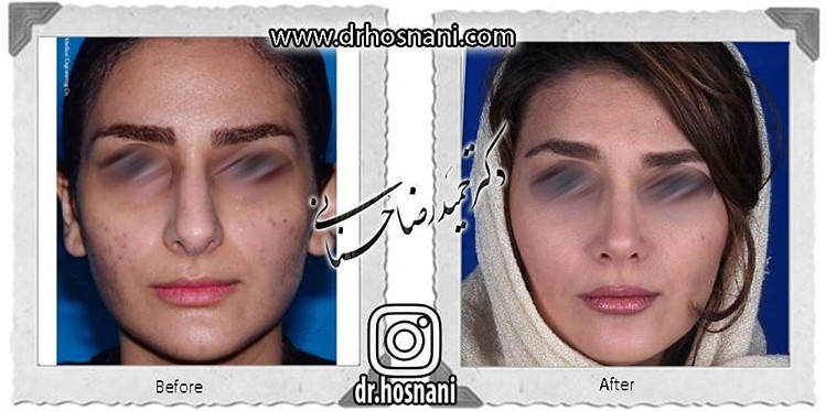 اصلاح انحراف بینی