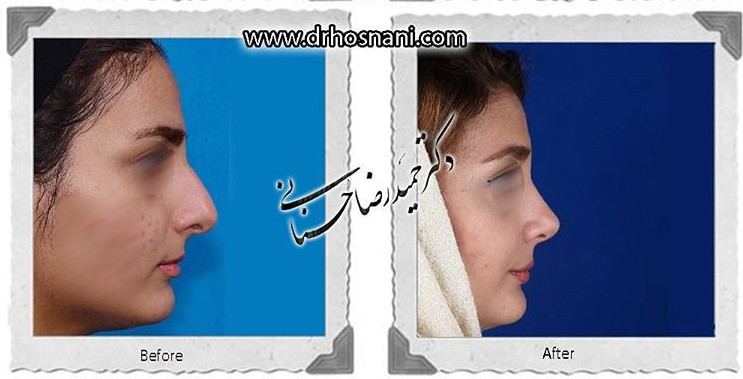 اصلاح انحراف بینی