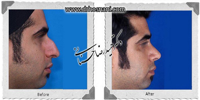 اصلاح انحراف بینی