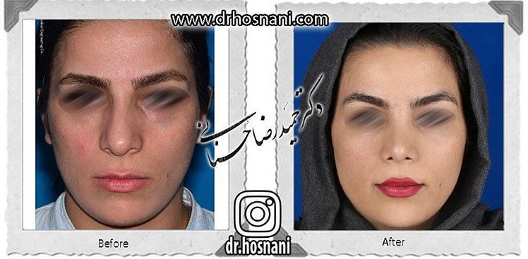 اصلاح انحراف بینی