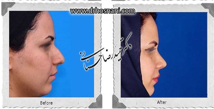 جراحی بینی