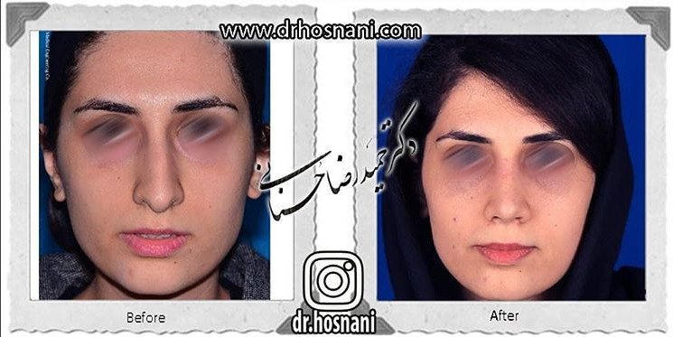اصلاح انحراف بینی