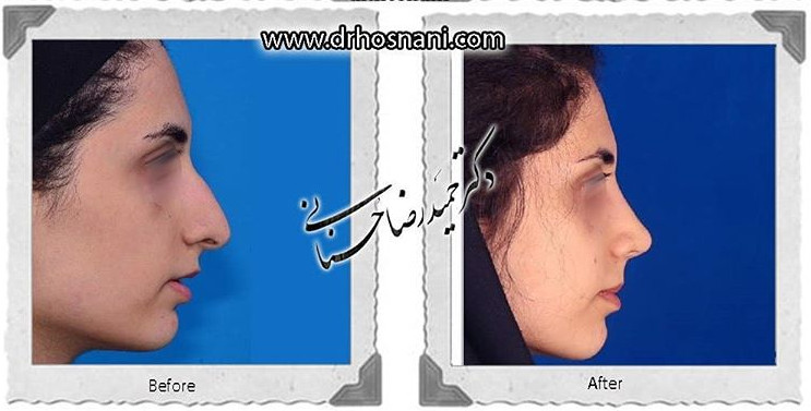اصلاح انحراف بینی