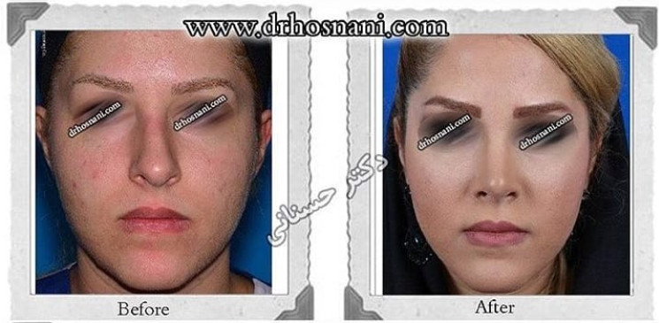 اصلاح انحراف بینی