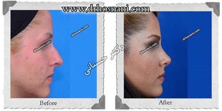 اصلاح انحراف بینی