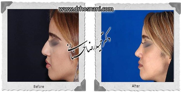اصلاح انحراف بینی