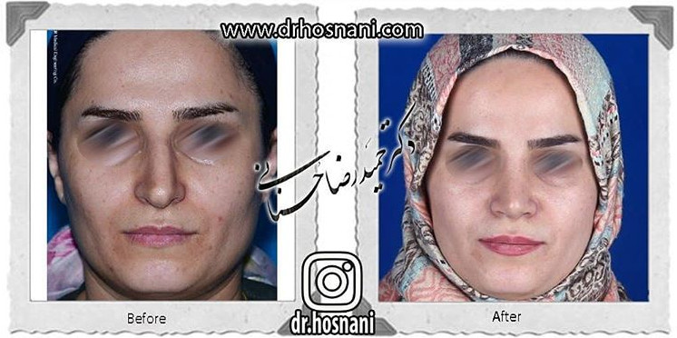 اصلاح انحراف بینی