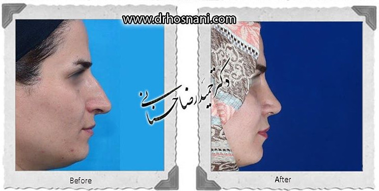 اصلاح انحراف بینی