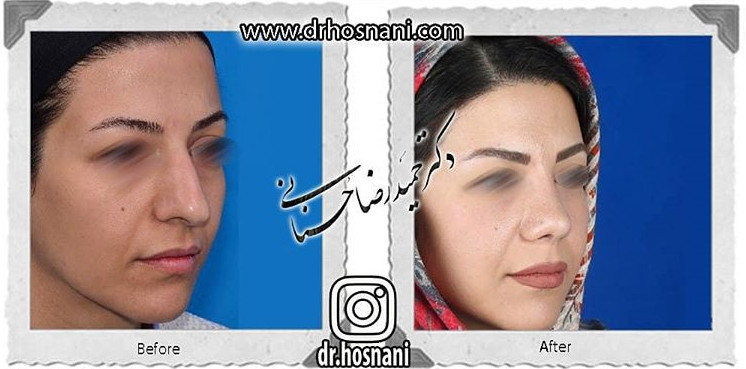 کاهش طول بینی