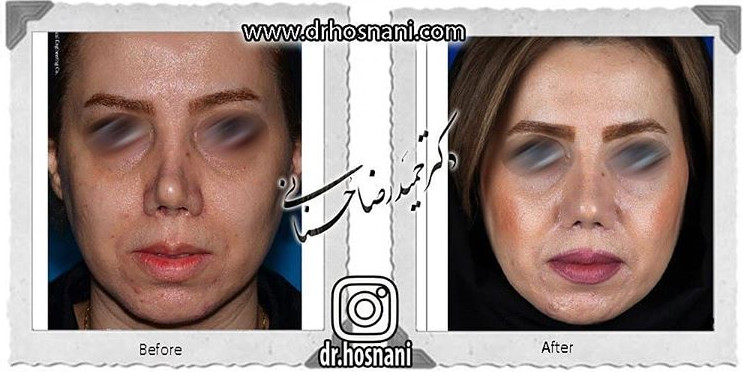 جراحی بینی