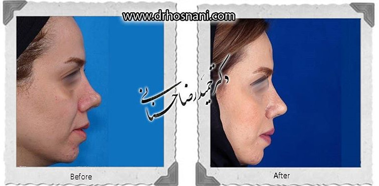  جراحی بینی -693
