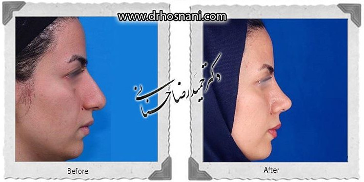 اصلاح انحراف بینی