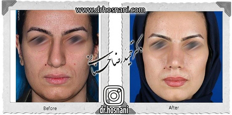 اصلاح انحراف بینی