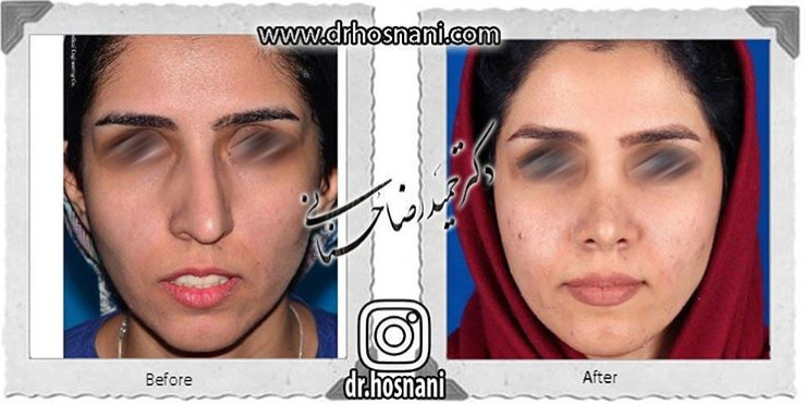اصلاح انحراف بینی