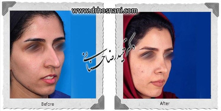 اصلاح انحراف بینی