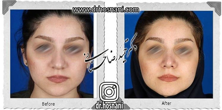  جراحی بینی -700
