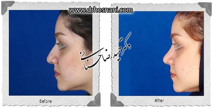  جراحی بینی -701
