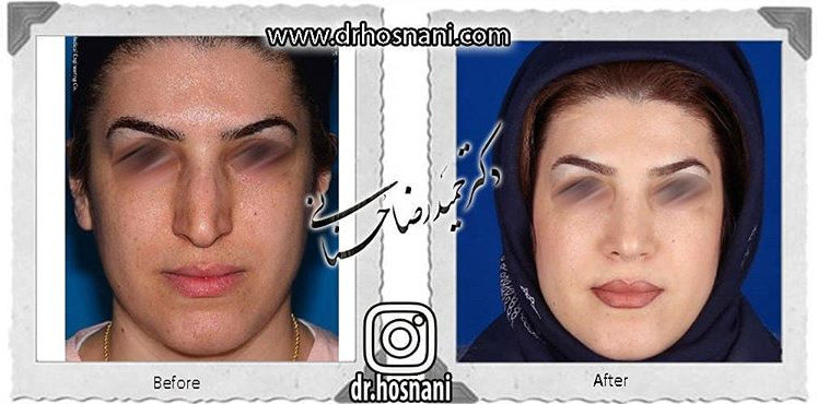  جراحی بینی -702