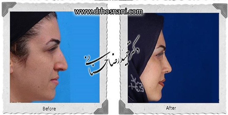 جراحی بینی -703