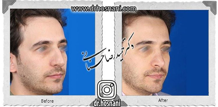  جراحی بینی -704