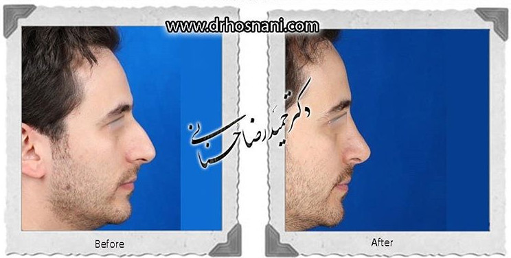  جراحی بینی -705