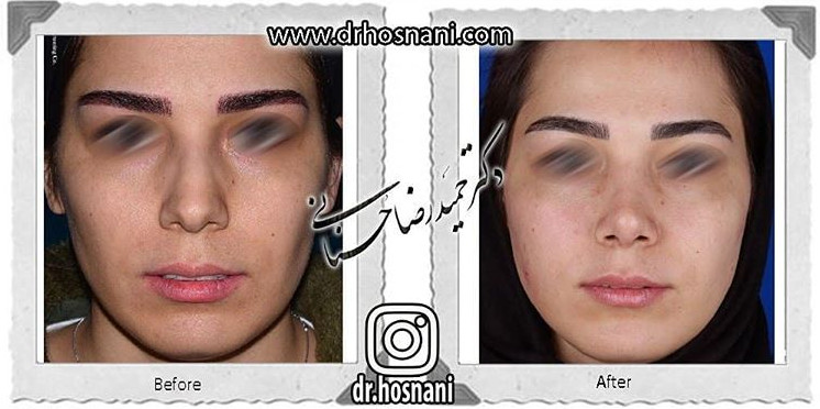  جراحی بینی -706