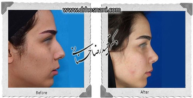  جراحی بینی -707