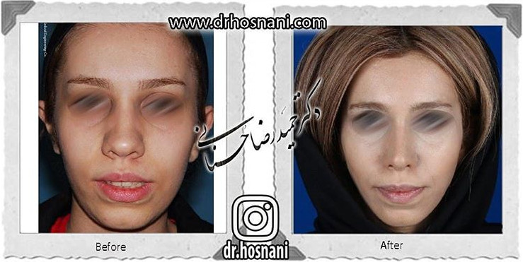 اصلاح انحراف بینی