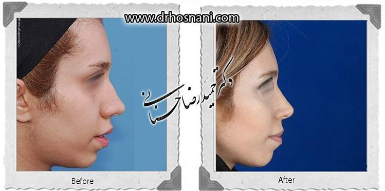 اصلاح انحراف بینی