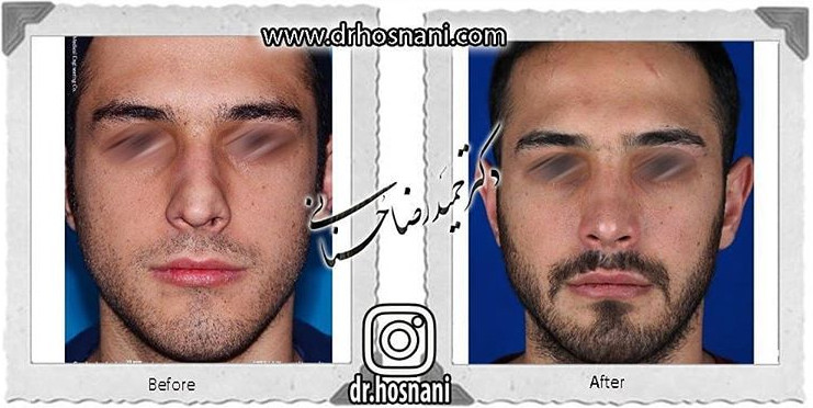  جراحی بینی -710