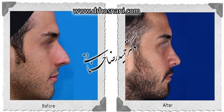  جراحی بینی -711