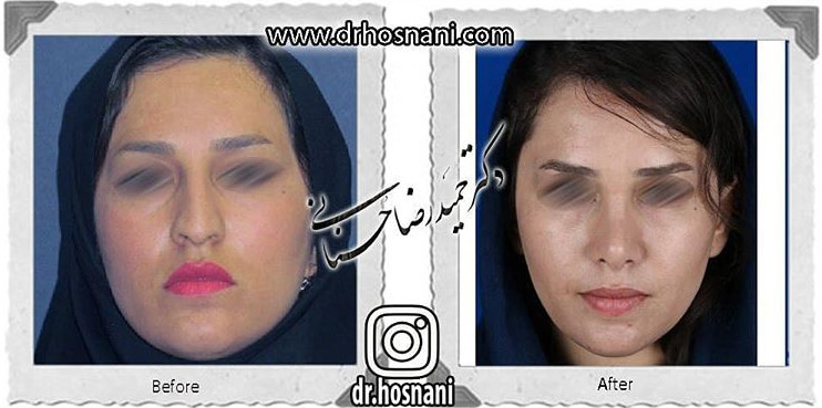  جراحی بینی -712