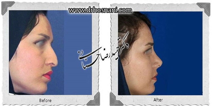  جراحی بینی -713