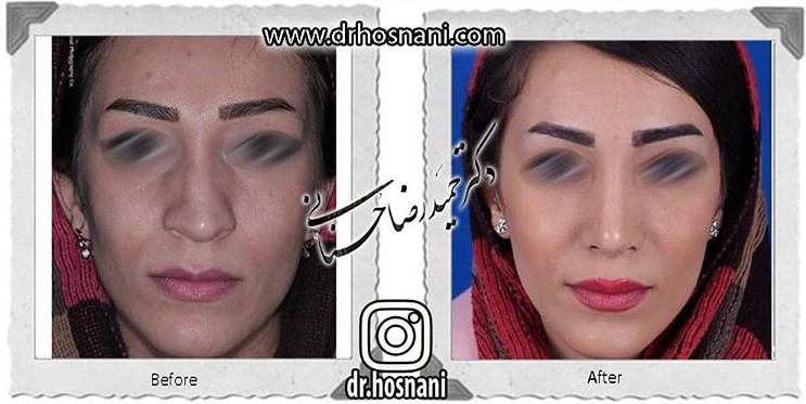 اصلاح انحراف بینی