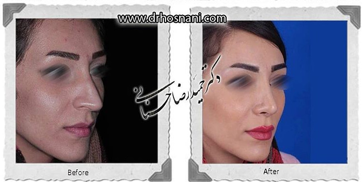 اصلاح انحراف بینی