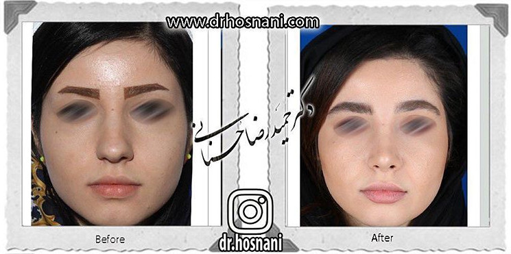 اصلاح انحراف بینی